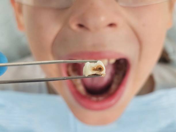 Best Emergency Wisdom Tooth Extraction in Walton Hills, OH